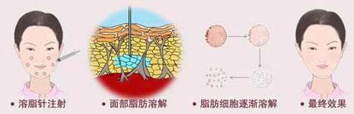 美莱注射吸脂减肥一般要多少钱啊