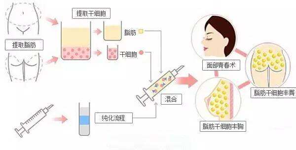 【美莱丰臀科普】做自体脂肪丰臀一般需要多少钱