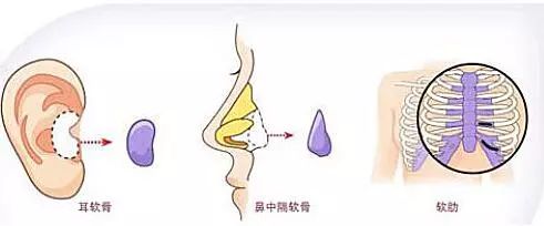 做完隆鼻整形，过了几十年会怎么样你们想过吗