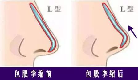 做完隆鼻整形，过了几十年会怎么样你们想过吗