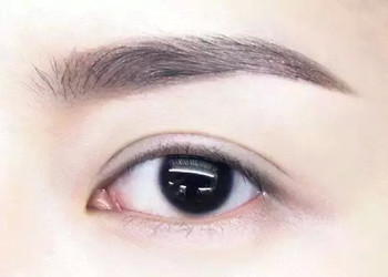 韩式埋线双眼皮大概能维持几年