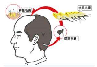 上海地区做毛发移植需要多少钱