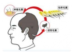 上海地区做毛发移植需要多少钱