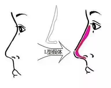 【上海美莱隆鼻分享】|假体、自体软骨、玻尿酸等隆鼻方式哪个更好