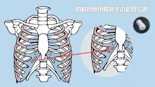 【上海美莱隆鼻分享】|假体、自体软骨、玻尿酸等隆鼻方式哪个更好