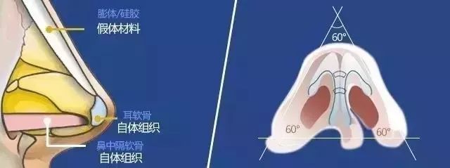 隆鼻失败？不满意？别急，在美莱还能重新变美