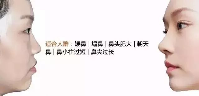 隆鼻失败？不满意？别急，在美莱还能重新变美