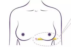 乳房下垂到底应该怎么办，如何进行矫正