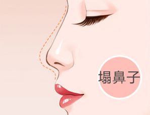 在上海做假体隆鼻，它的可以维持多久