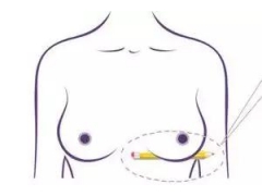 乳房下垂到底应该怎么办,如何进行矫正