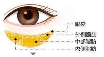 上海艺星对于眼睛有炎症的人，是不适宜进行眼部吸脂的，如结膜炎、睑缘炎、严重砂眼者都应该等治愈后再进行手术，这样才能有效避免伤口感染。