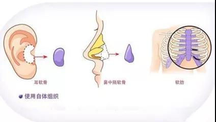 美莱做隆鼻整形手术有危险吗