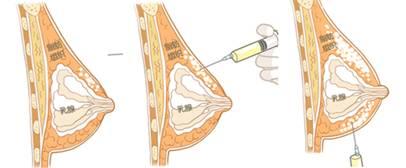 注射隆胸一般取出得需要多少钱
