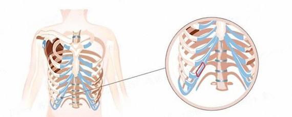 上海做肋骨隆鼻修复需要注意什么