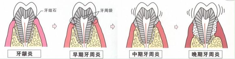 【美莱口腔牙齿】牙周炎不可小觑