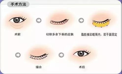 上海做完祛眼袋手术后可以用热水敷吗