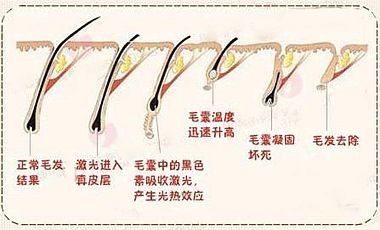 上海做激光脱毛一般需要多少钱？费用是多少