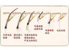 上海做激光脱毛一般需要多少钱?费用是多少