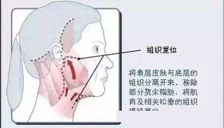 美莱做面部除皱价格一般是多少钱