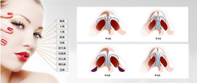 上海一些医院做鼻综合整形手术多少钱