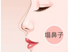 做了假体垫鼻子是不是几年都没事