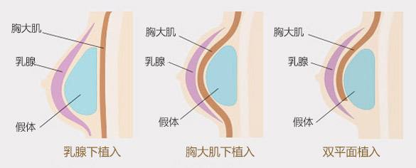 隆胸假体该怎么选择，你选对了吗