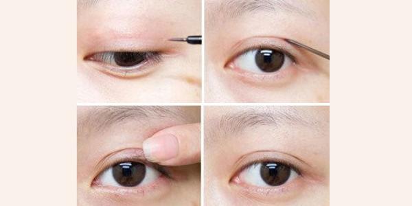 做切开双眼皮手术大约要多少钱在上海