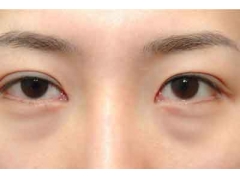 上海美莱免拆祛眼袋的优势是什么