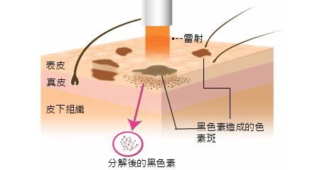 美莱做了激光祛斑后还会再长吗