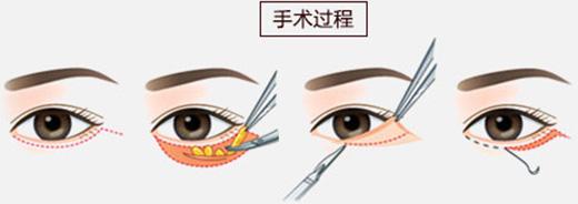 <a href='/' target='_blank'><u>上海整形</u></a>医院排行去眼袋的价格是怎么样的