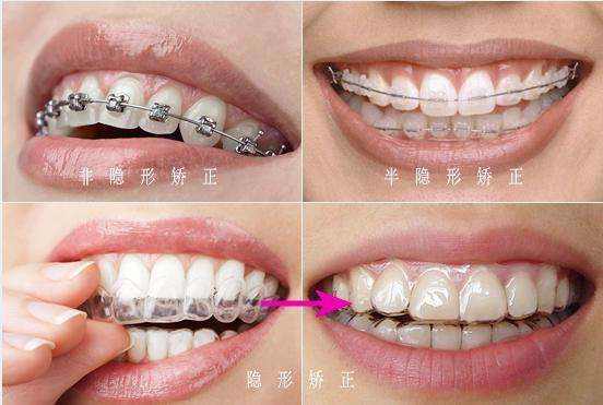 【美莱牙齿矫正】产生牙间隙的原因很多，你读懂了吗