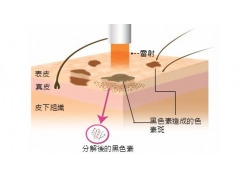 美莱做了激光祛斑后还会再长吗