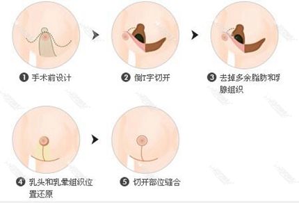 乳头过大怎么办,上海做乳头缩小术选哪种好