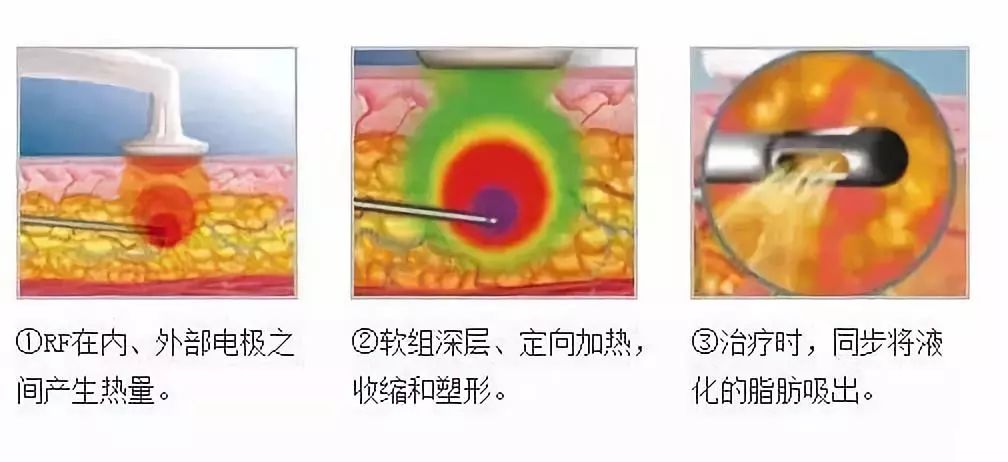 黄金微雕和传统吸脂，您搞清楚了没