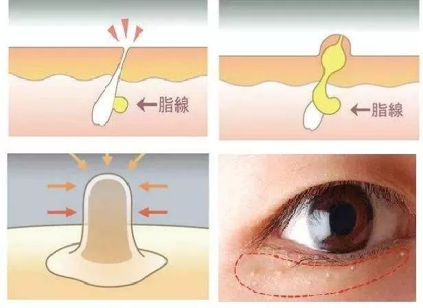 眼皮上长脂肪粒，通过眼部吸脂可以直接去除吗