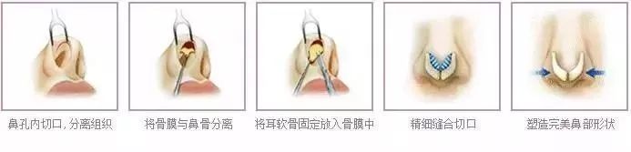 耳软骨鼻子上海哪个医院做的好些
