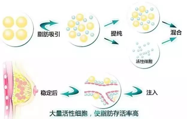 19岁怎么做自体脂肪丰胸