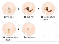 乳头过大怎么办,上海做乳头缩小术选哪种好