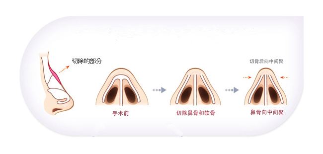 驼峰鼻矫正价格是怎么样的在上海