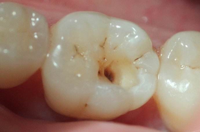 牙齿里面有个洞很痛该怎么办吗，美莱如何治疗