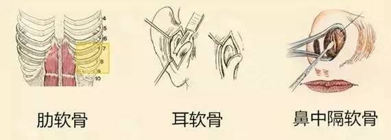 在上海做了自体软骨隆鼻术后会被吸收吗