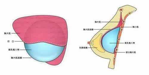 上海做了假体置放到体内之后切口怎么办