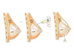 注射隆胸得多少钱啊在上海