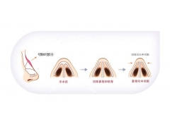 驼峰鼻矫正价格是怎么样的在上海