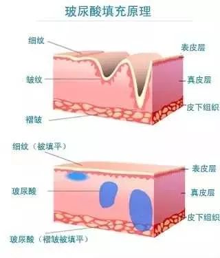 美莱科普|注射玻尿酸后皮肤会变得很松弛吗