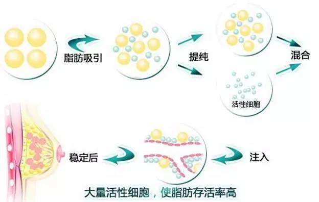 太瘦的人能做自体脂肪隆胸手术吗