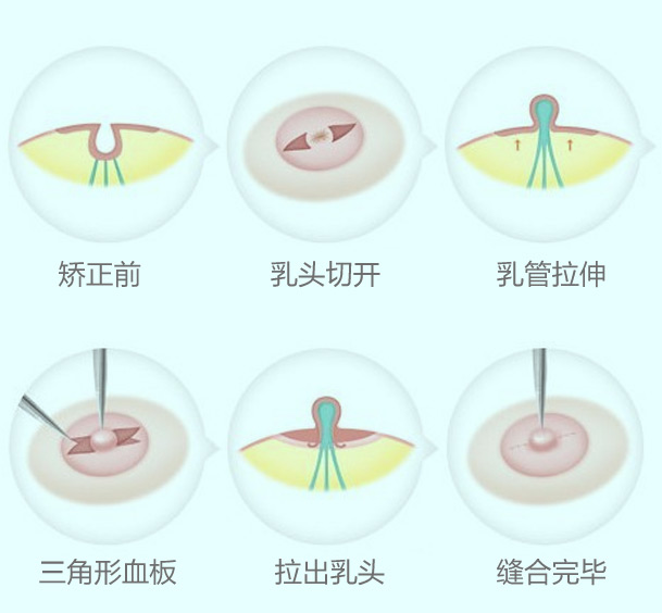 美莱乳头内陷矫正