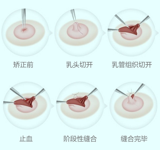 美莱乳头内陷矫正