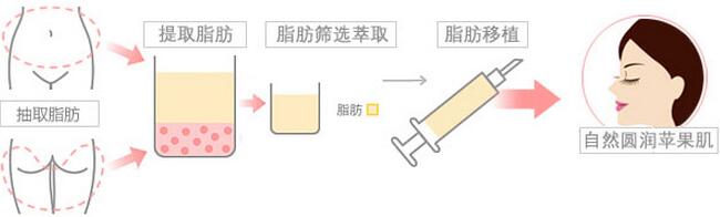 美莱科普 | 自体脂肪填充术后护理有哪些