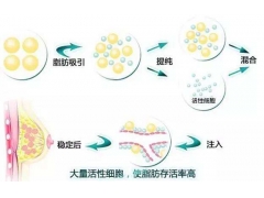 太瘦的人能做自体脂肪隆胸手术吗